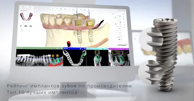 Зубные импланты в 72 года