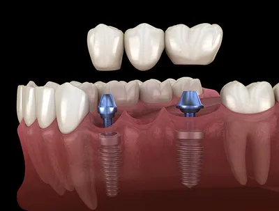 Корейские зубные импланты [виды, отзывы и цены]