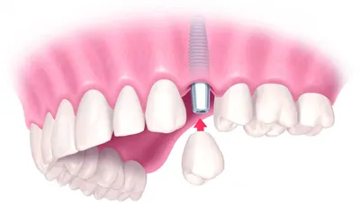 Самые лучшие зубные импланты — статьи «Зубная Формула»