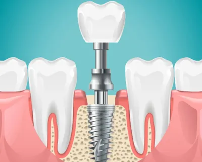 Сколько стоит заменить все зубы на импланты? Полная имплантация зубов -  Bookimed
