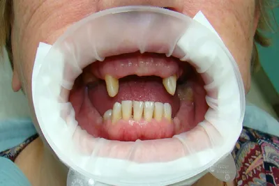 Съемные зубные протезы: цена в Москве на протезирование в клинике  стоматологии, изготовление и установка на челюсть