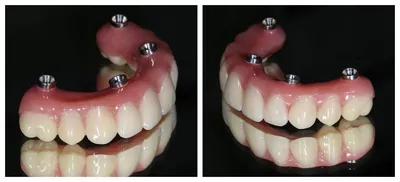 Съёмный, частично съёмный зубной протез на нижнюю челюсть – Denta-Labor