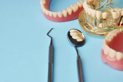 Зубные протезы без нёба в Уфе | Стоматология Риадент