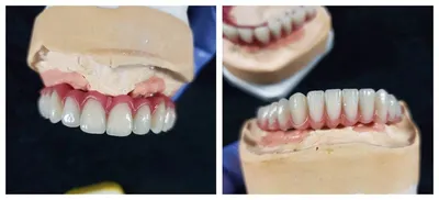 Съемные зубные протезы [виды, материалы, цены и уход]