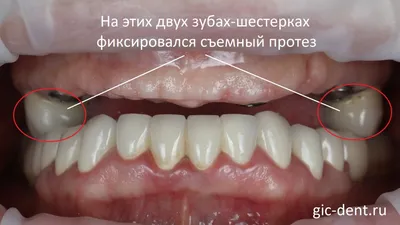 Установить бюгельный протез зубов в Хабаровске | цена от 40 000 руб.