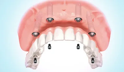 ᐈ Съемные зубные протезы в Запорожье • Цены • Съемное протезирование ⇒  Nikolov Dental Clinic