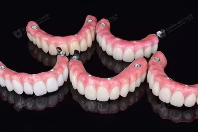 Съемные протезы на имплантах при полном отсутствии зубов