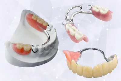 Что такое бюгельный протез на зубы? | Стоматология Smile-at-Once | Дзен