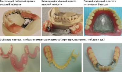 Съемные зубные протезы в Сочи - Цены на съемное протезирование зубов