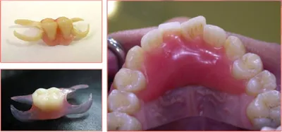 Полные съемные зубные протезы, цены в СПб в стоматологии «Жемчужина Севера»