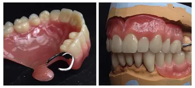 ЗУБНЫЕ ПРОТЕЗЫ. Статья о разных видах протезов зубов.
