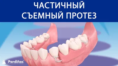 Бюгельные зубные протезы на верхнюю и нижнюю челюсть [виды и цены]