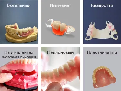 Съемные зубные протезы – цена, виды, без неба, фото, отзывы