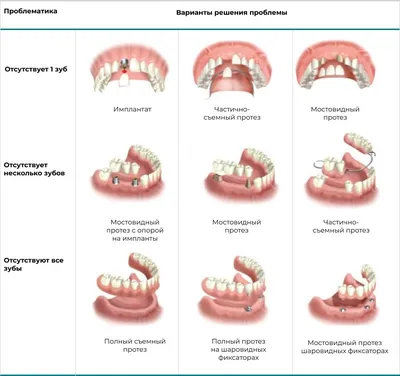 Съемные зубные протезы - виды, как выбрать и ухаживать? | Giorno Dentale