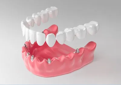 Зубные протезы: виды, способы фиксации, материалы изготовления