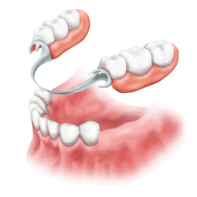Зубные протезы в Нижнем Новгороде и Щербинках – протезирование в  стоматологии Смайлик