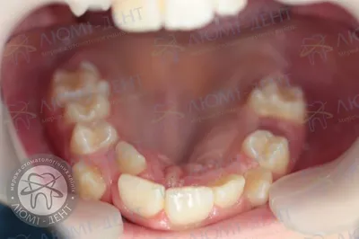 Сверхкомплектные Зубы Стоматология ЛюмиДент