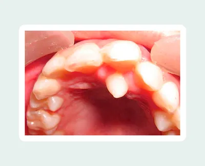 Зуб(растёт в нёбе) с двигает другой зуб. - Терапия - Стоматология для всех