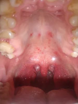 крупный рот человека с очень плохими зубами Стоковое Изображение -  изображение насчитывающей протез, заболевание: 222522093