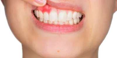 all on 4 ( протезирование на 4-х имплантах) - Ортодонтия и Детская  стоматология