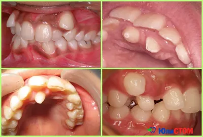 Планирование лечения эндодонтически пораженных зубов (2065) - Терапия -  Новости и статьи по стоматологии - Профессиональный стоматологический  портал (сайт) «Клуб стоматологов»