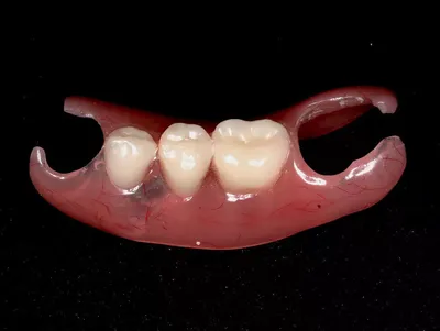 Зубные протезы без неба нового поколения: цены и особенности - Стоматология  Елены Мокренко
