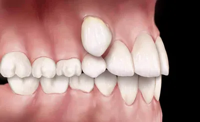 Съемные зубные протезы – цена, виды, без неба, фото, отзывы