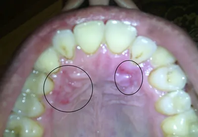 Воспаление нёба - форум Стоматология.Су