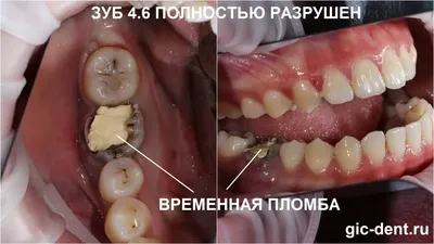 ЛЕЧЕНИЕ \"БЕЗНАДЕЖНЫХ\" ЗУБОВ | Спасибо.Клиник | Дзен