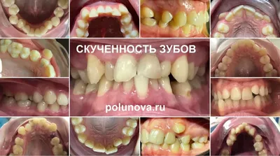 Новый случай пересадки зуба: верхняя восьмерка на место нижней шестерки  (18→36). | Спасибо.Клиник | Дзен