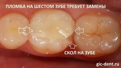 Нужно ли удалять зубы мудрости: нужны ли зубы мудрости, советы экспертов.