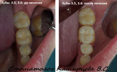 Коронка из диоксида циркония в СПб - Стоматологическая клиника \"Галерея  Улыбок\"