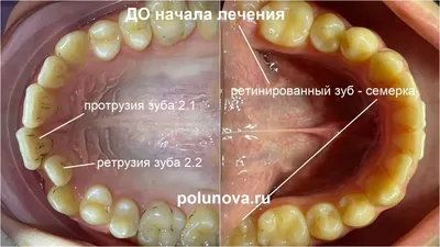 Моя Стоматология� - Как в стоматологии нумеруются зубы ? ❓ Большинство из  нас, сидя в кабинете стоматолога, слышали странные числовые термины,  используемые врачами для обозначения проблемных зубов — «шестерка»,  «восьмерка», «тройка» и