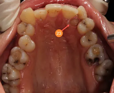 История одной улыбки или рассказ о том как даже «зуб мудрости» пригодился  :: NORD DENTAL — семейная стоматология. Две клиники на севере Петербурга