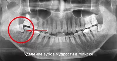 Зубы мудрости: когда и как удаляют, противопоказания