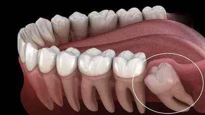 Зубы мудрости: зачем нужны, как и где растут, когда их нужно удалять, как  их лечить, стоимость