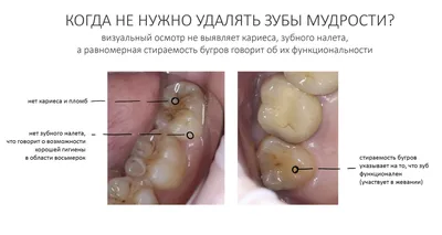 Нужно ли удалять зубы мудрости | Рекомендации стоматолога по удалению  восьмерки