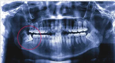 Болит зуб мудрости [снять боль, причины, лечение и удаление]