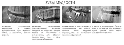 Удаление зуба мудрости в Москве, цены