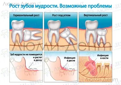 Удаление нижнего и верхнего зуба мудрости