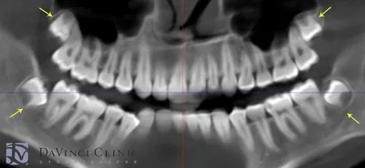 У всех ли есть зубы мудрости? | Стоматология \"Ультра-Дент\" | Дзен