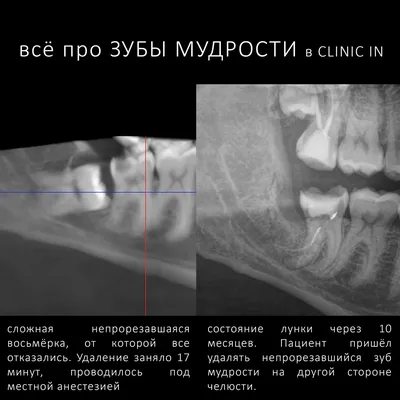 Корень Зуба Мудрости Сколько Их Восьмерка Восьмой ЛюмиДент