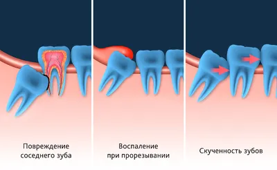 Можно ли сохранить премоляры, удалив зубы мудрости? Эквивалентна ли замена  восьмерки вместо четверок?