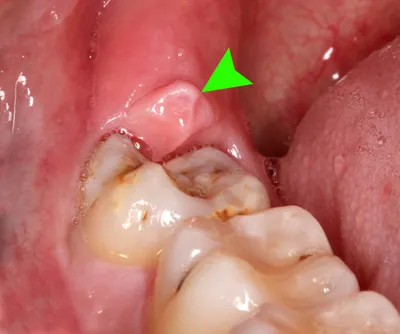 всё про ЗУБЫ МУДРОСТИ в CLINIC IN — IMPLANT-IN.COM — дентальная  имплантация. естественно.