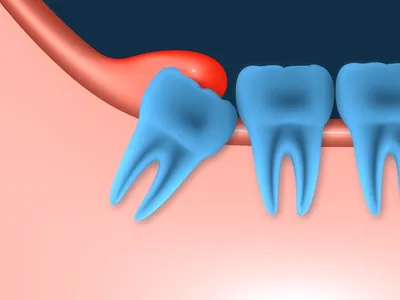 Удалять или оставлять зубы мудрости? :: NORD DENTAL — семейная  стоматология. Две клиники на севере Петербурга