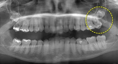 Зуб Мудрости. Удалять или нет || Никс Стоматологическая клиника