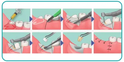 Нужно ли удалять зубы мудрости - показания, противопоказания к удалению  зубов мудрости, как проводится операция