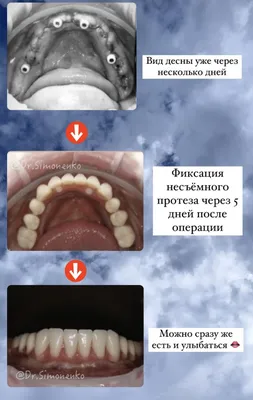 Зубы мудрости удалять или оставлять - Стоматология DDC