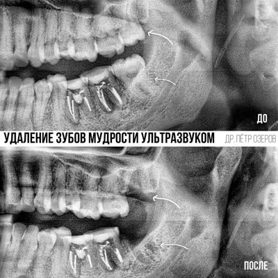 Удаление зубов мудрости - стоматология Профидент