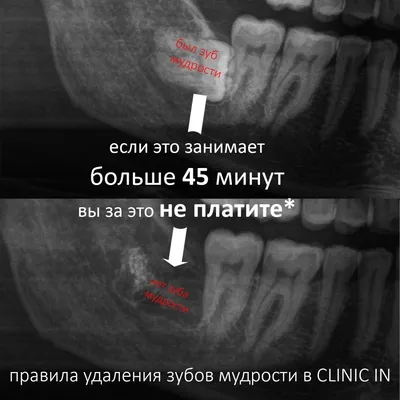 Удаление зуба мудрости ультразвуком Piezosurgery®. Без боли.